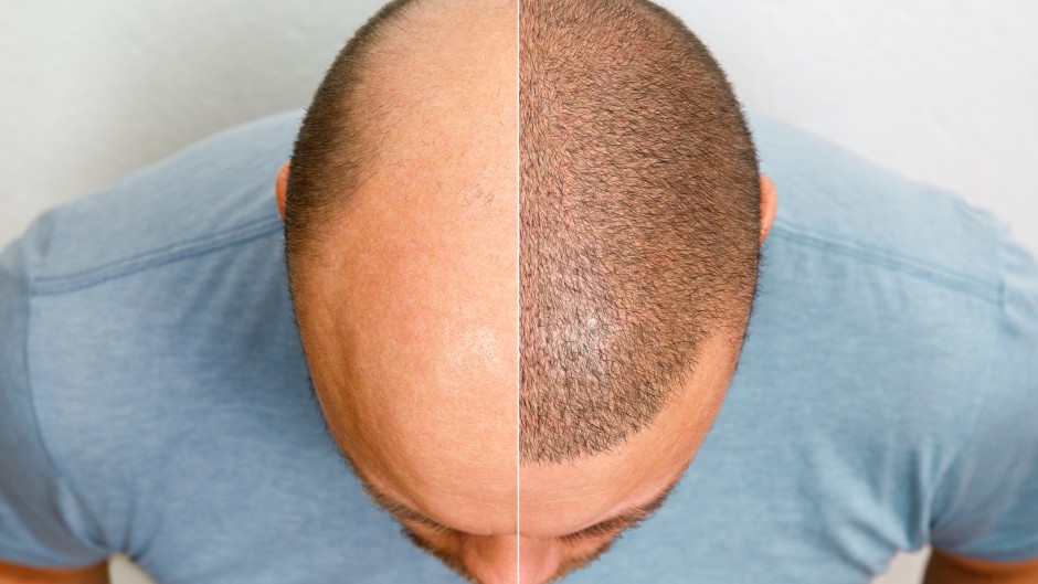 File: The head of a balding man before and after hair transplant surgery. Getty Images/Aleksandr Ryabalko