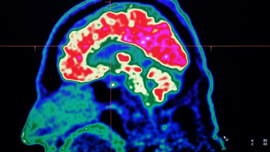 Neurological conditions have overtaken heart disease as the leading cause of disability and early death