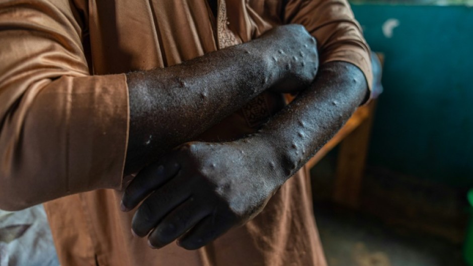 An mpox patient at a health centre in eastern DRC