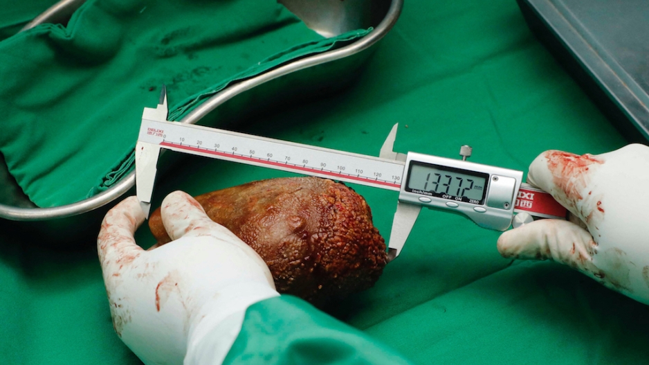 sri-lanka-doctors-remove-world-s-largest-kidney-stone-enca