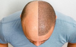 File: The head of a balding man before and after hair transplant surgery. Getty Images/Aleksandr Ryabalko