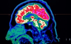 Neurological conditions have overtaken heart disease as the leading cause of disability and early death